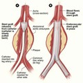Treatment of the Occlusive Peripheral Arterial Disease