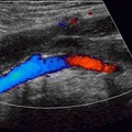 Vein Thrombosis