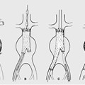 Endovascular Aneurysm Repair