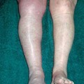 Vein Thrombosis