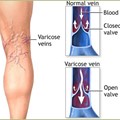 Varicose Veins in the Extremities - Causes