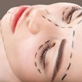 Ρυτιδεκτομή (Facelift)