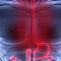 Treatment of gastroesophageal reflux disease, diaphragmatic hernia