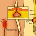 Pilonidal cyst, treatment