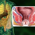 Anal fissure, treatment