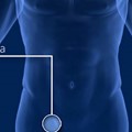 Inguinal hernia, laparoscopic method of repair