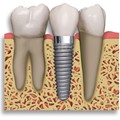 Prosthetics, titanium implants