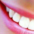 Tooth whitening