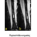 Tibial crest periostitis in an athlete