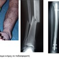 Tibia fracture in a football player