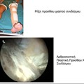 Anterior cruciate ligament rupture