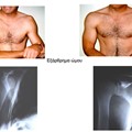 Dislocated shoulder
