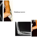 Dislocated elbow