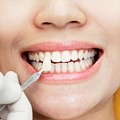 Porcelain Veneers