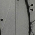Angiography - angioplasty