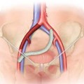 Aortoiliac bypass