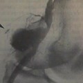 Popliteal artery aneurysm