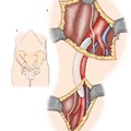 Iliofemoral bypass