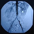 Aortoiliac occlusive disease angiography