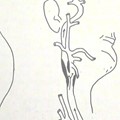 Carotid artery stenosis