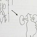 Aneurysm - AAA dilatation