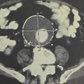 Abdominal aortic aneurysm