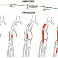 Intermittent claudication