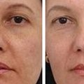 Facial relaxation