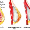 Breast augmentation