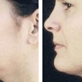 Smart Lipo