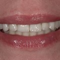 All-ceramic veneers
