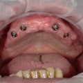 Implants
