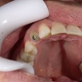 Implants