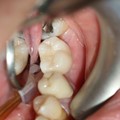 Implants