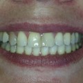 All-ceramic veneers