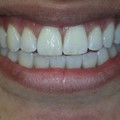 Teeth whitening