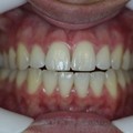 Teeth whitening