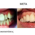 Ολοκεραμική αποκατάσταση