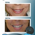 Αποτέλεσμα με Ορθοδοντική μέθοδο Invisalign