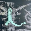 Θεραπεία σοβαρής ΧΑΠ - πνευμονικού εμφυσήματος με ενδοβρογχικές βαλβίδες (ELVR)