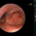 Εφαρμογή επαναστατικών τεχνικών (CBCT) στη διάγνωση και αντιμετώπιση του καρκίνου του πνεύμονα