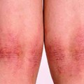 Atopic Dermatitis