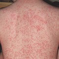 Drug Allergy