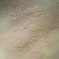 Urticaria