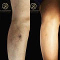 Foam Sclerotherapy