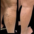 Ultrasound guided foam sclerotherapy