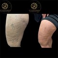 Thigh vein treatment