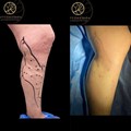 Varicose veins laser