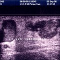 Thrombosis of the Venous Nodes of the Great Saphenous Vein