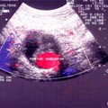 Thrombosis of the Great Saphenous Vein